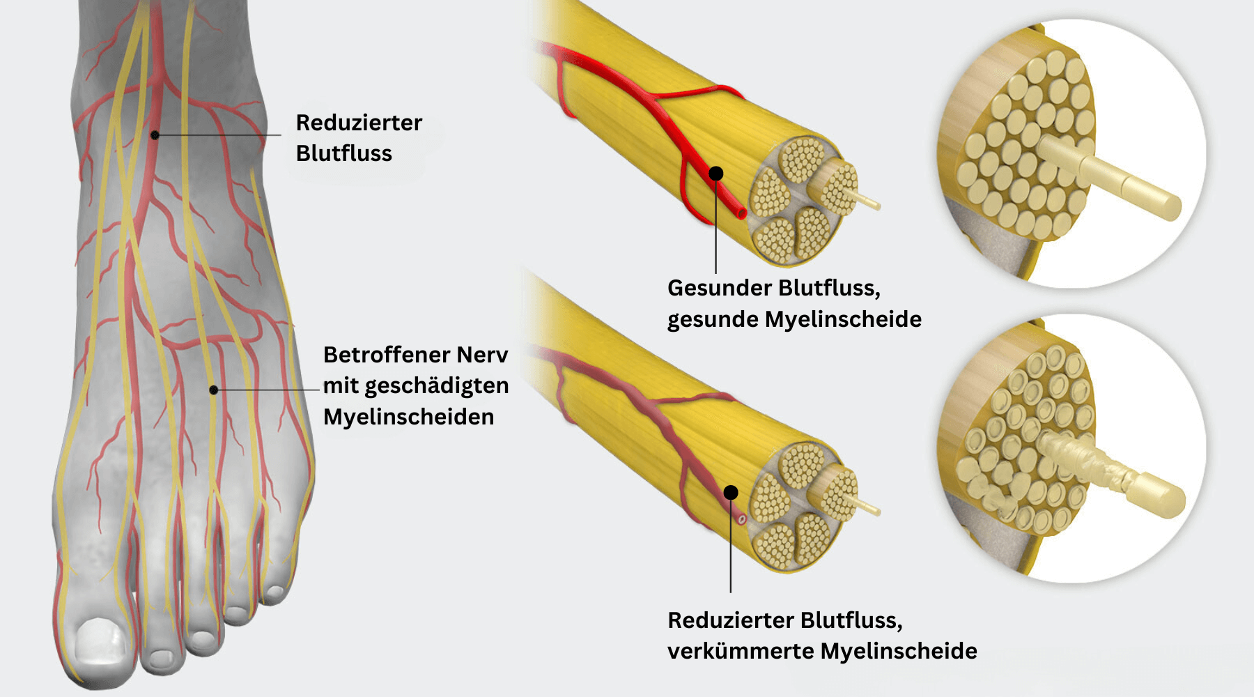 Polyneuropathie 1722003797375